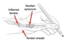 Parts of the hand and wrist affected by deQuervain's Tendonitis