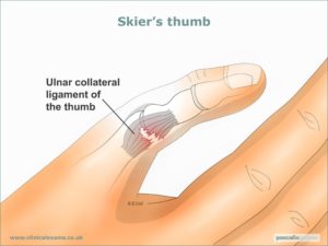Ulnar collateral ligament damage
