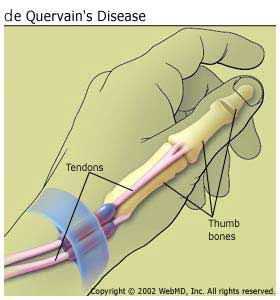 Today's Texter's Thumb is  actually de Quervain's Disease.