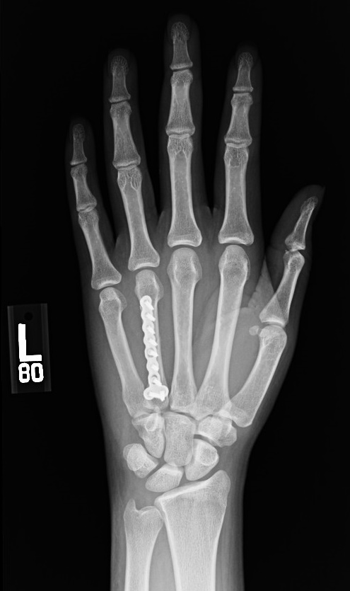 Metacarpal hand fracture repair