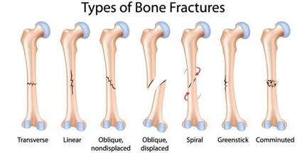 Fracture type can vary and are treated differently in the adolescent child and adult.