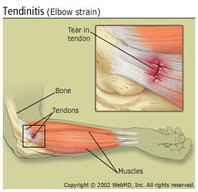 arthritis_tendinitis_elbow_strain