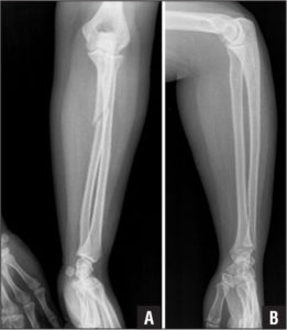 Stress Fracture of Elbow