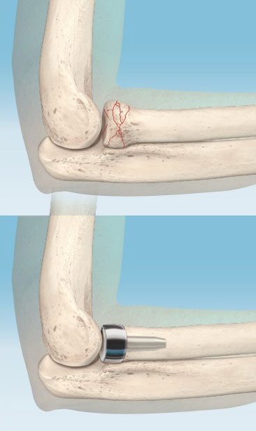 Radial Head Fracture Repair of the Elbow