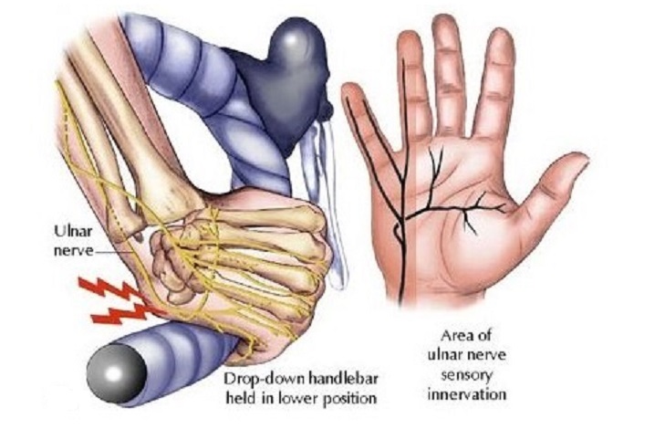Handlebar palsy affects the ulnar nerve.